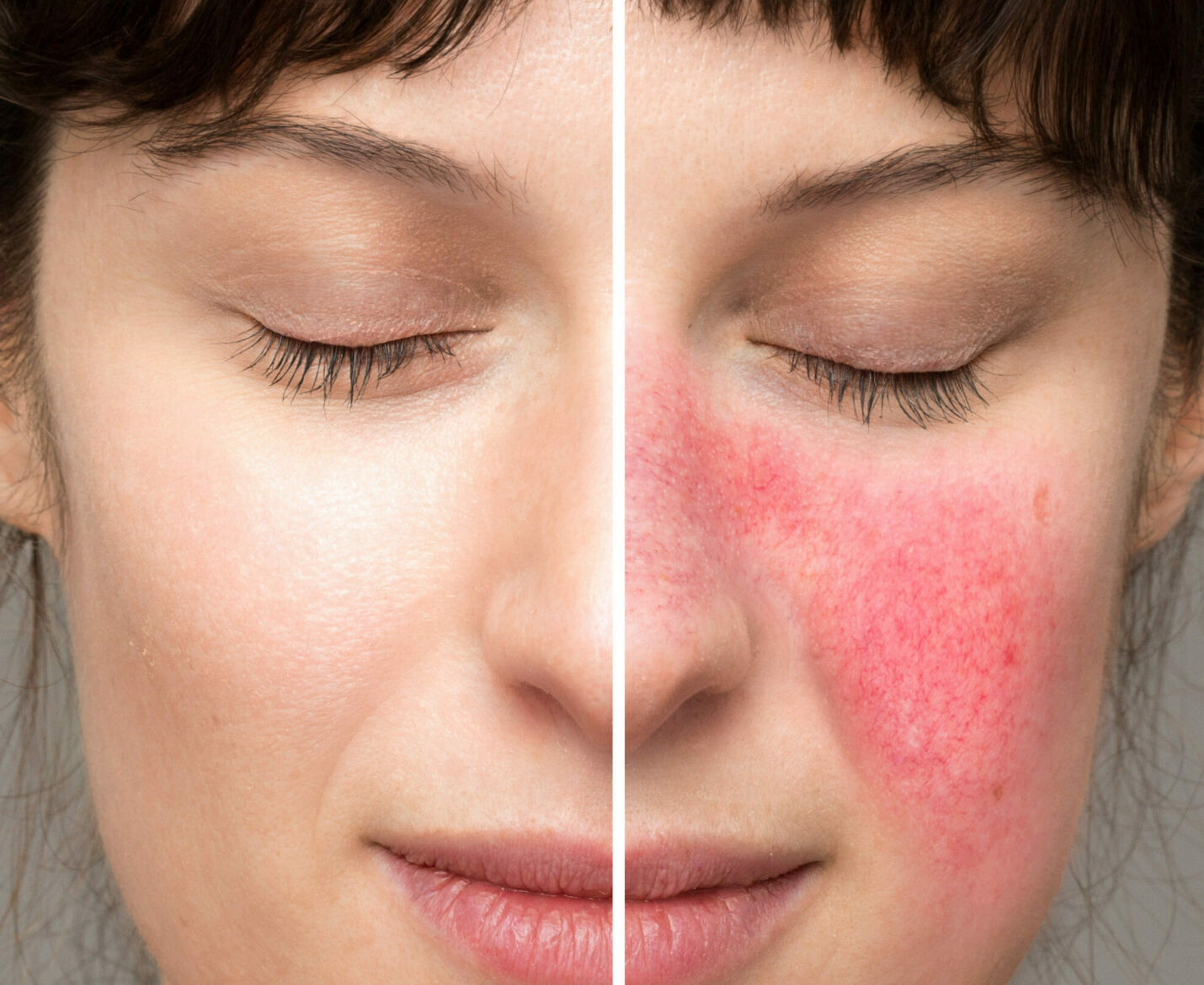 Rosacea