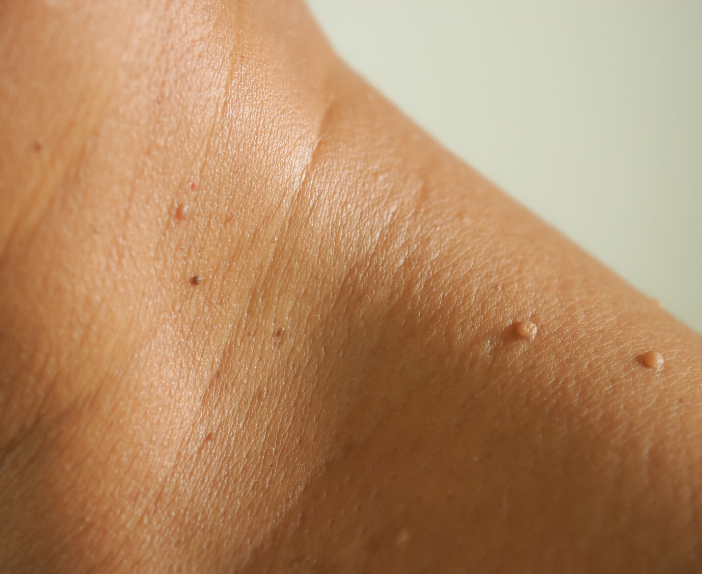 Skin Blemishes Removal