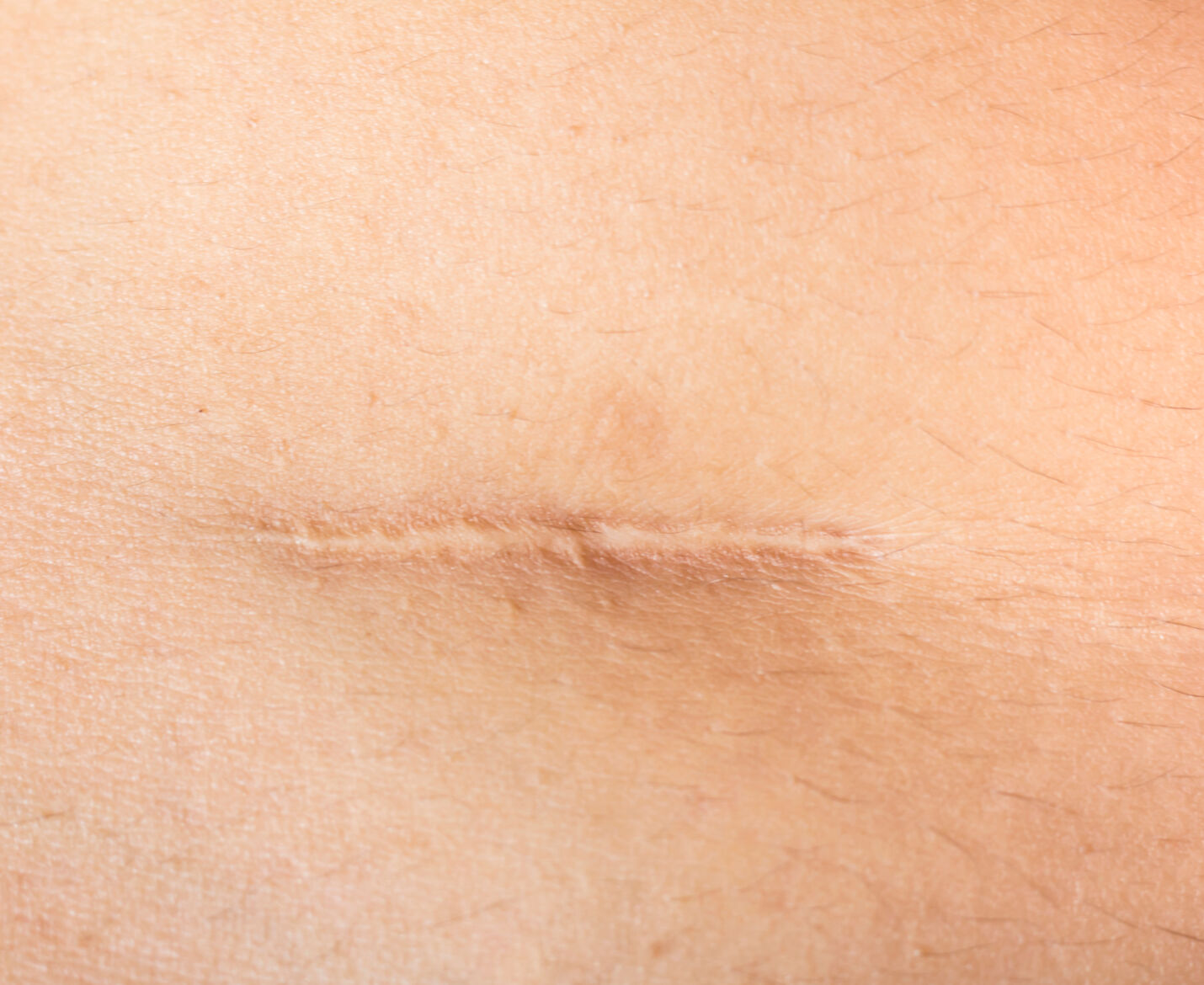 Scar Management & Removal